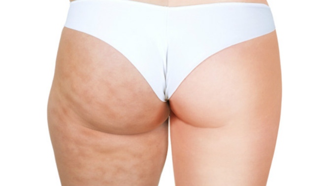 cellulite